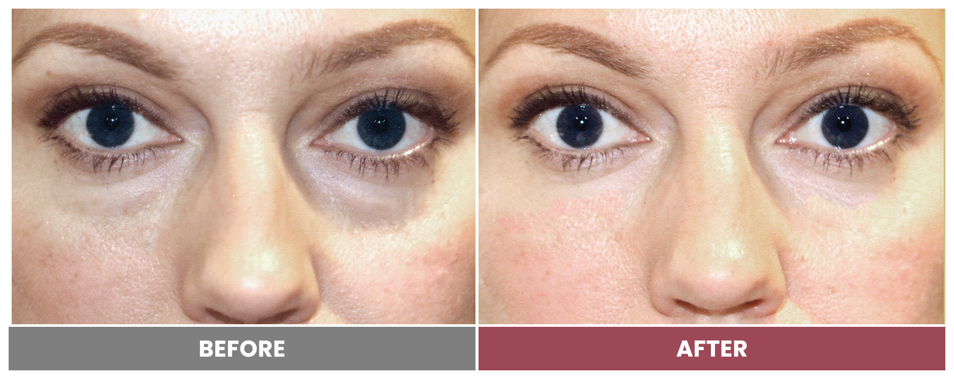 5D FACE LIFT - Case 1