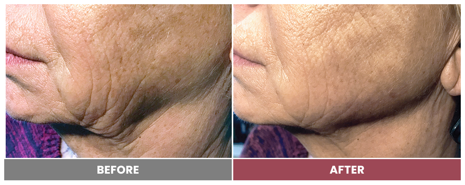 5D FACE LIFT - Case 2