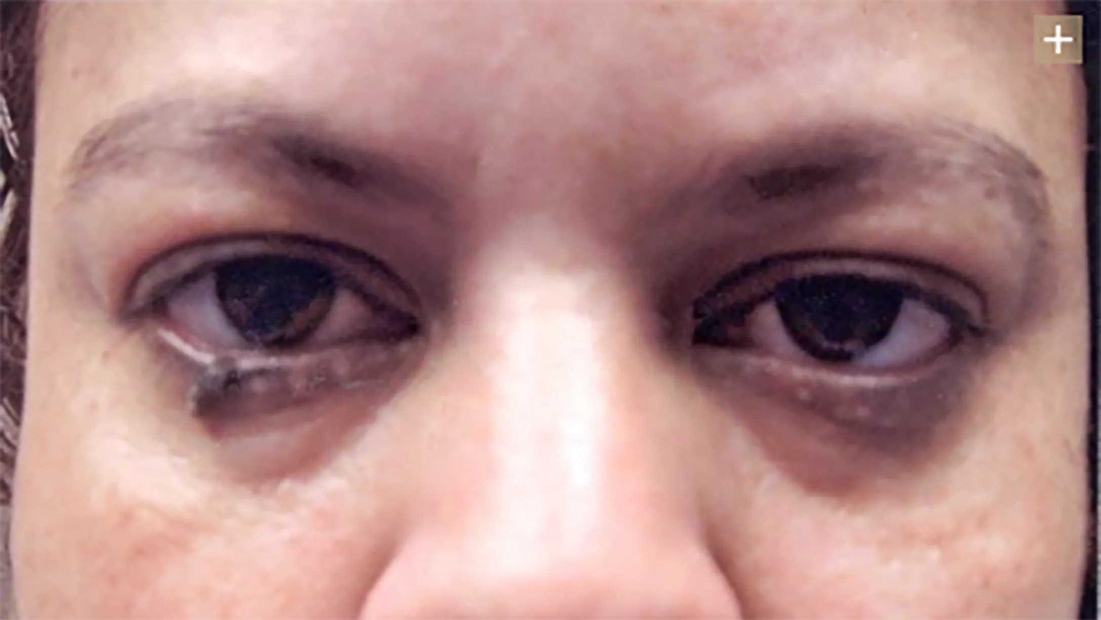 EYELID SKIN CANCER EXCISION - Case 1
