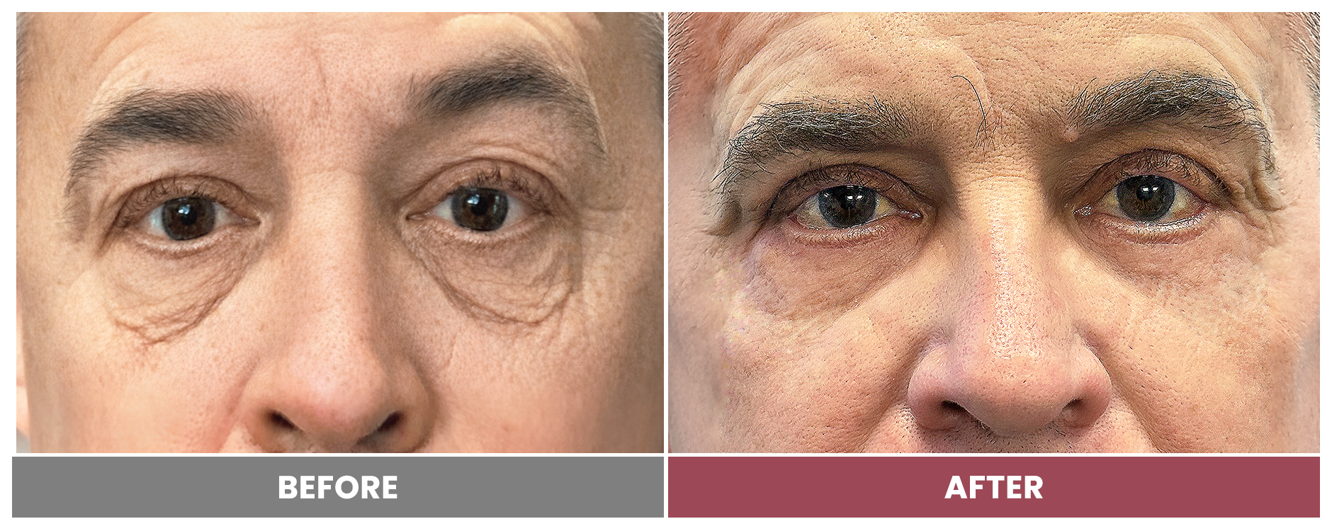 5D EYEBAG REMOVAL - Case 1