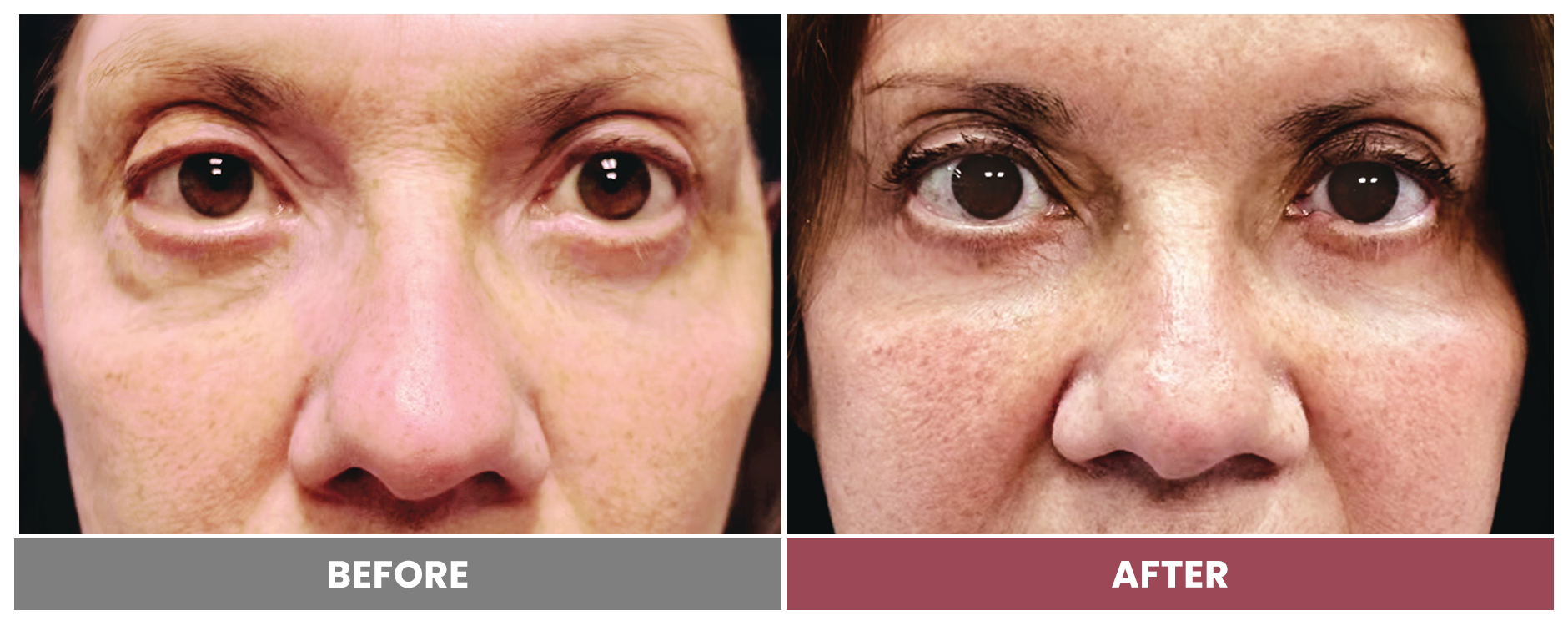 5D EYEBAG REMOVAL - Case 2