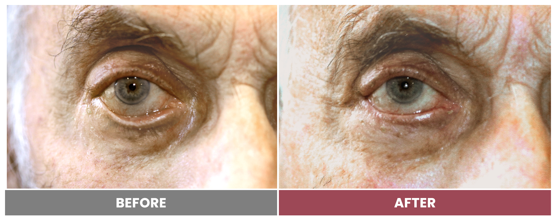 ECTROPION Repair - Case 10