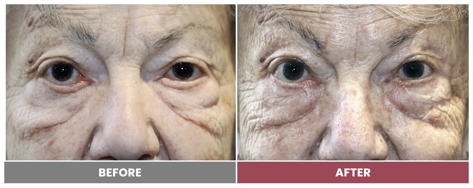 ECTROPION Repair - Case 12