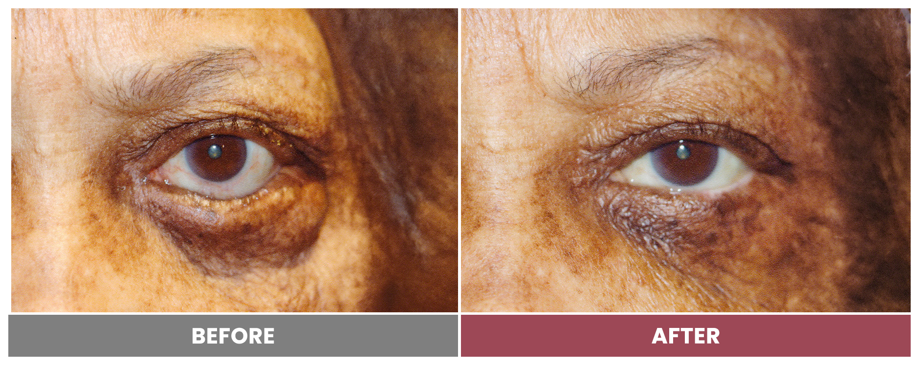 ECTROPION Repair - Case 13