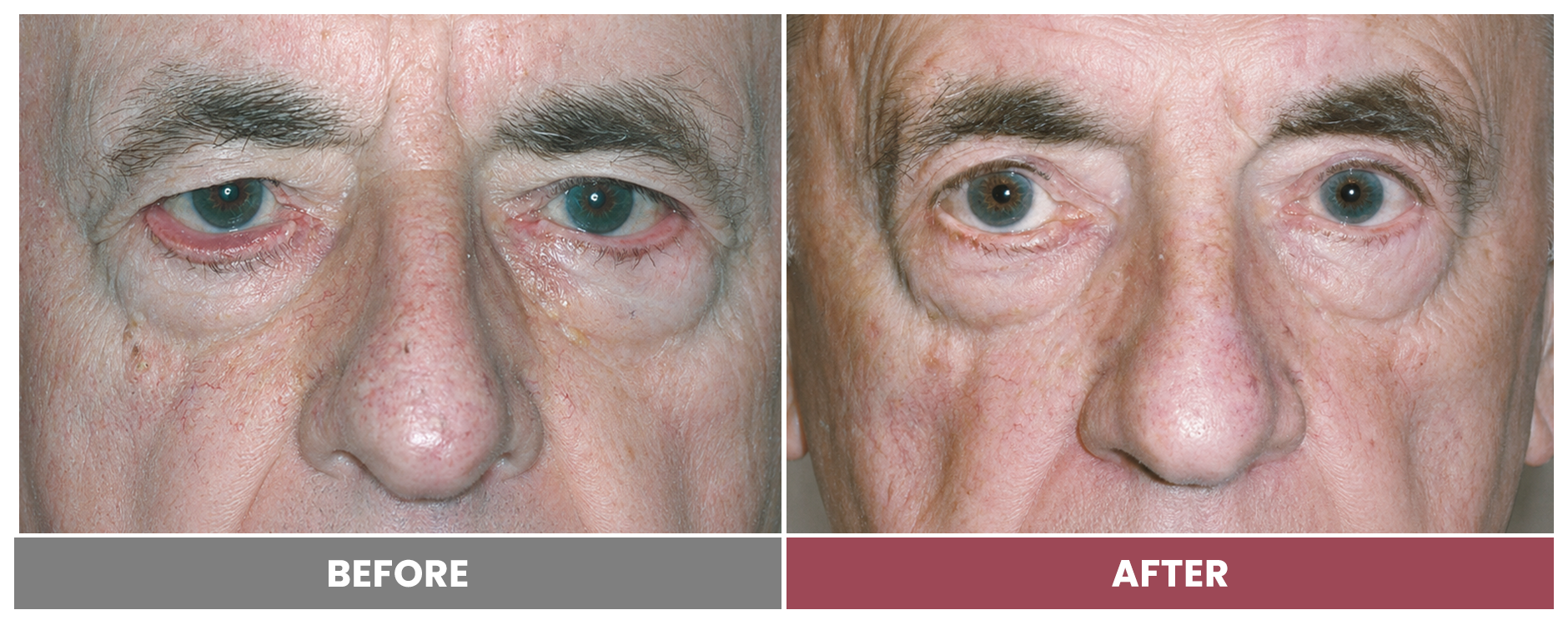 ECTROPION Repair - Case 2