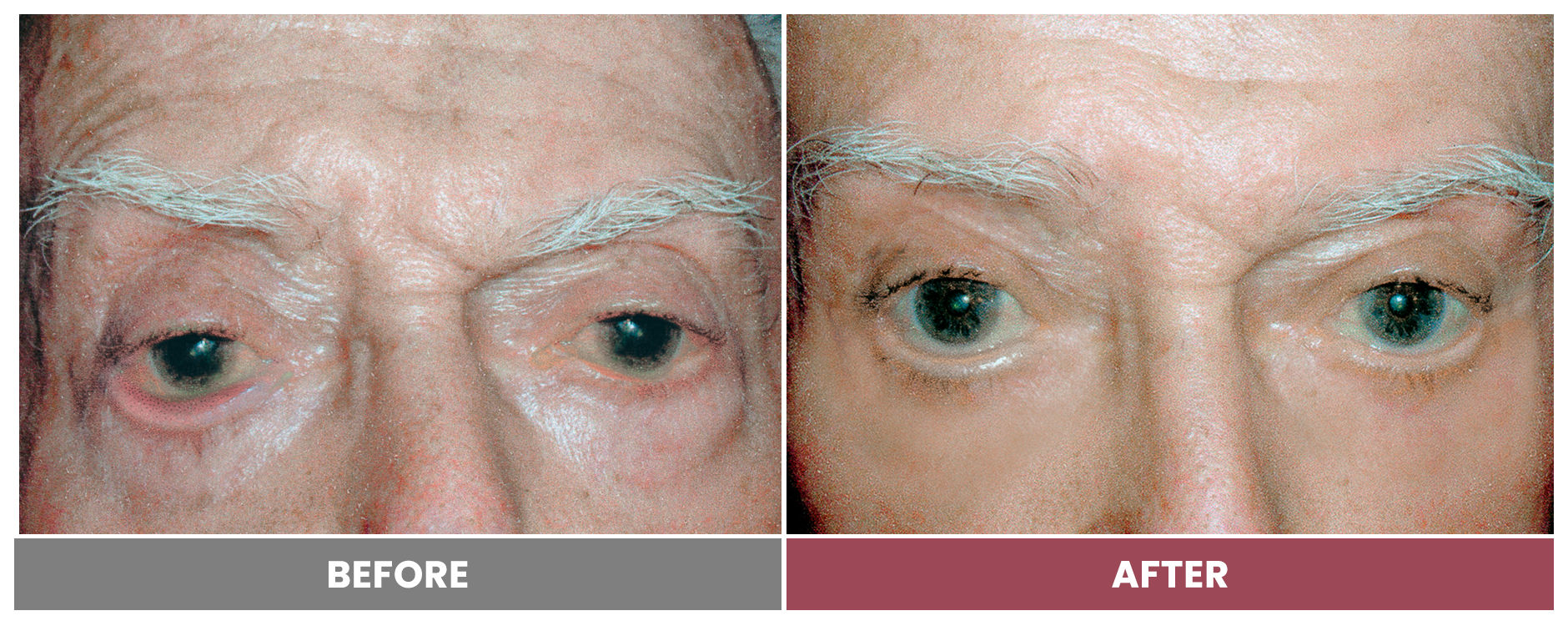 ECTROPION Repair - Case 3
