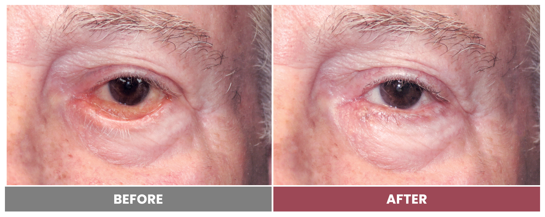 ECTROPION Repair - Case 4