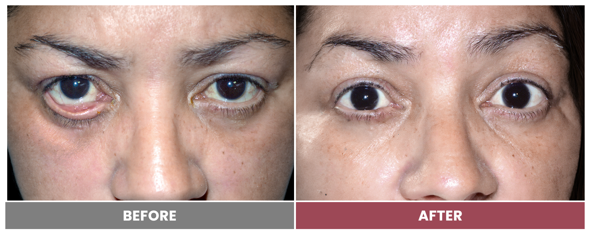 ECTROPION Repair - Case 5