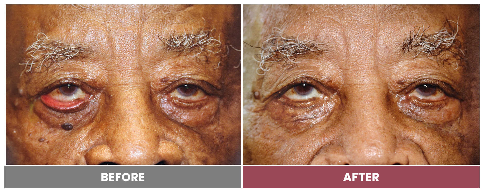 ECTROPION Repair - Case 6