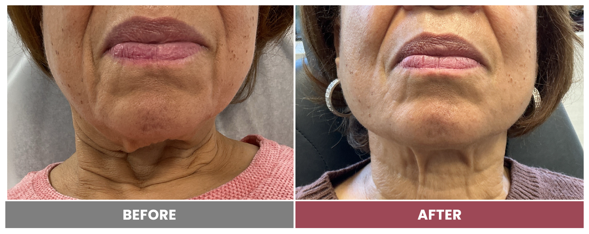PDO THREAD LIFT FOR SKIN TIGHTENING - Case 1