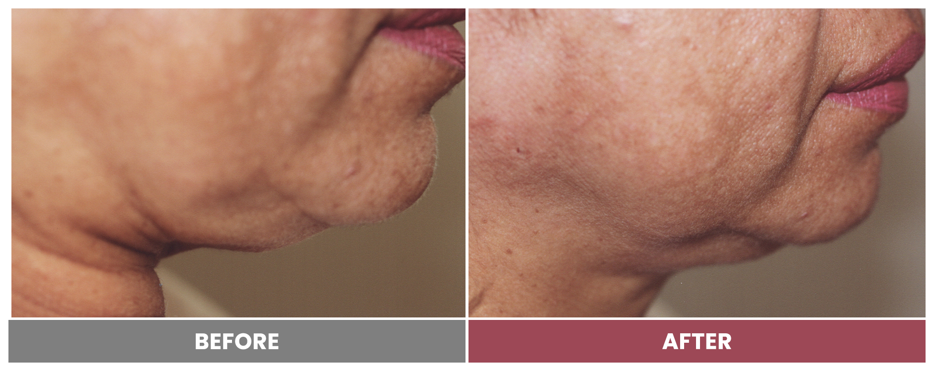 PDO THREAD LIFT FOR SKIN TIGHTENING - Case 2