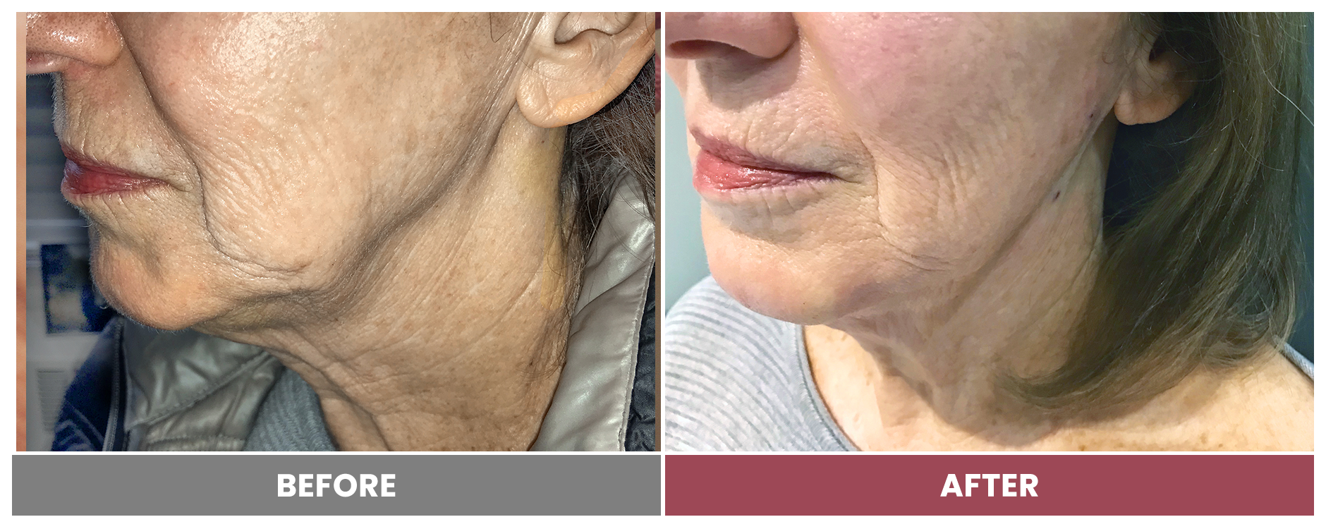 PDO THREAD LIFT FOR SKIN TIGHTENING - Case 3