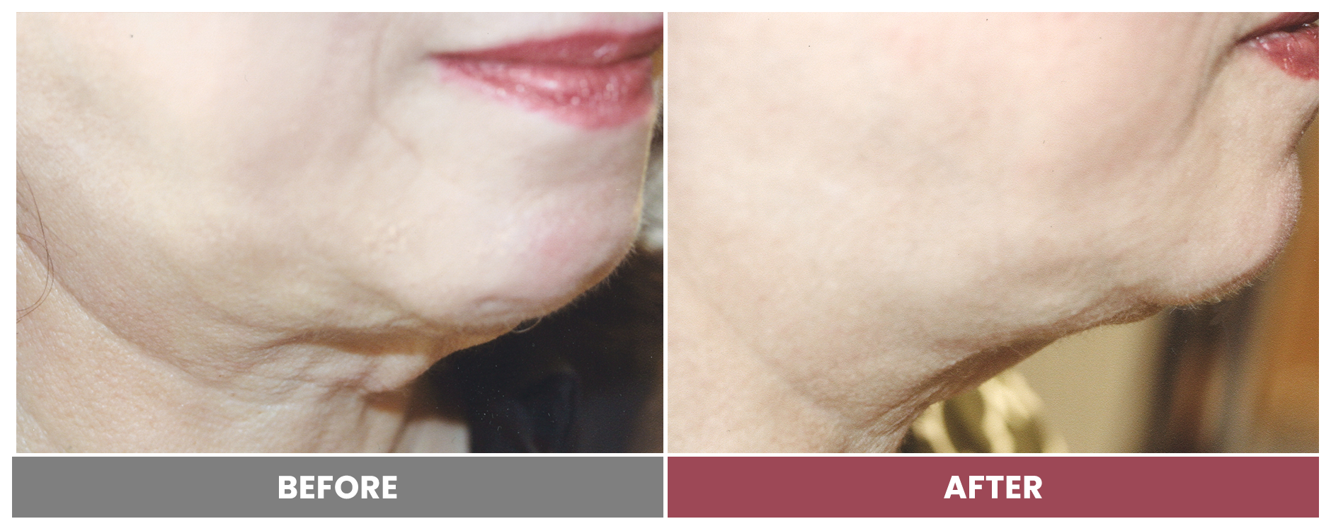 PDO THREAD LIFT FOR SKIN TIGHTENING - Case 4