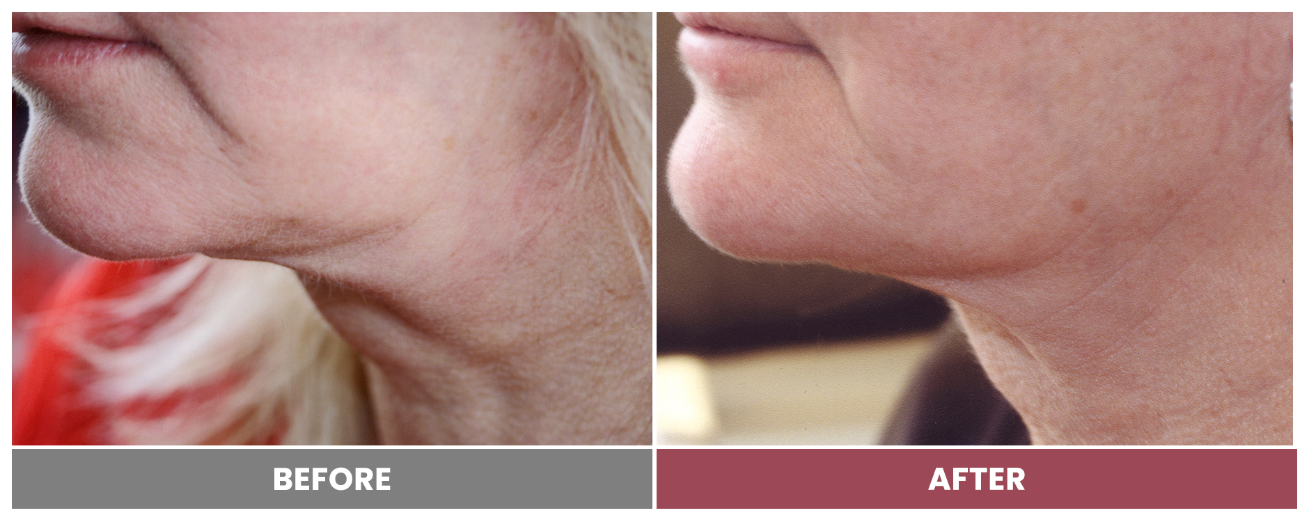 PDO THREAD LIFT FOR SKIN TIGHTENING - Case 5