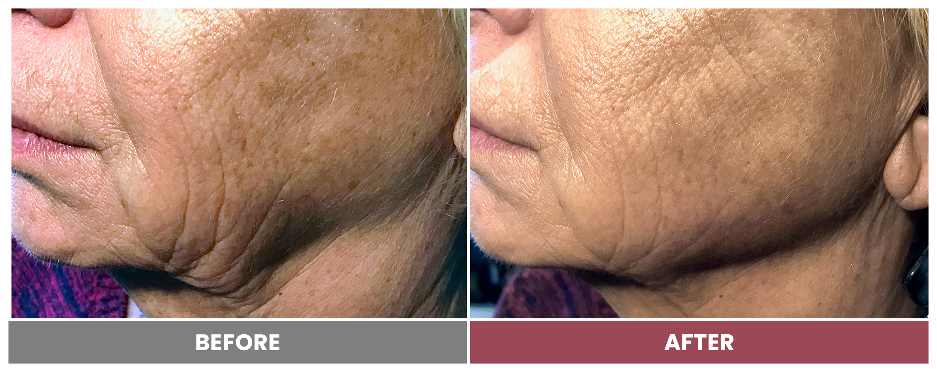 PDO THREAD LIFT FOR SKIN TIGHTENING - Case 6