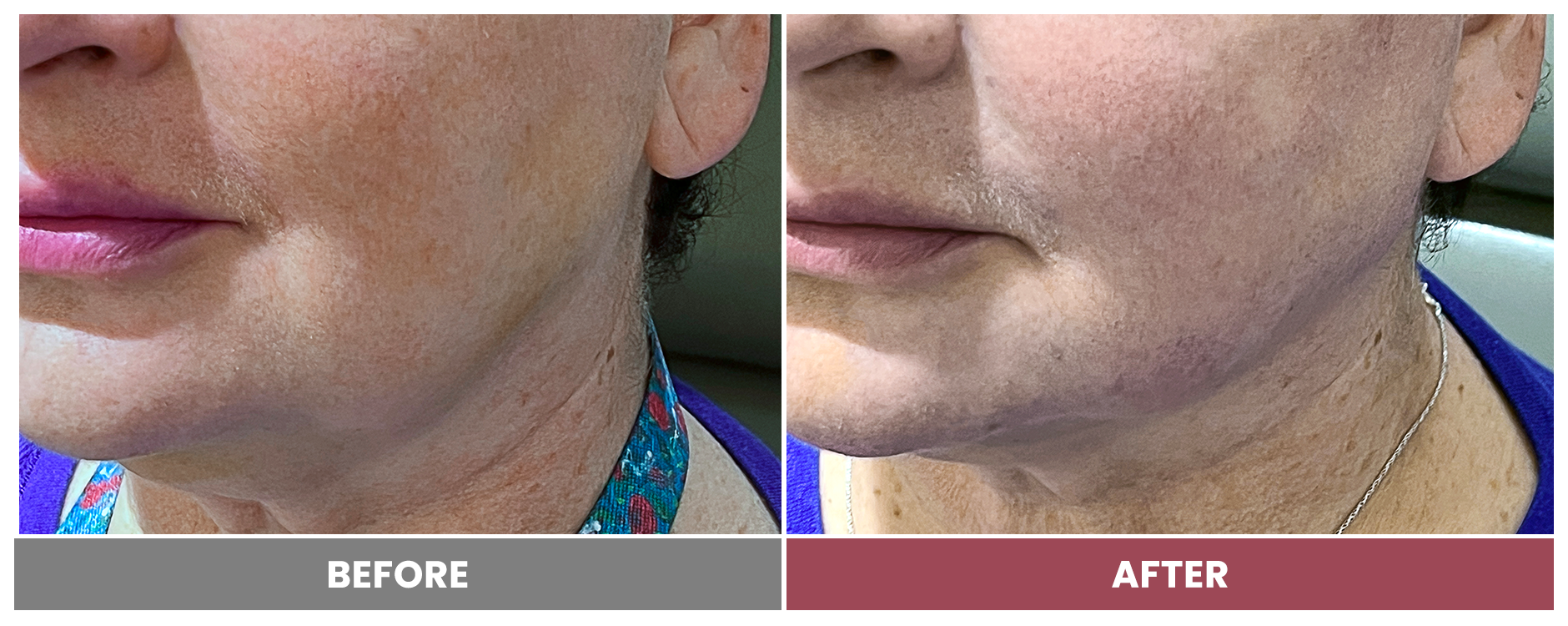 PDO THREAD LIFT FOR SKIN TIGHTENING - Case 7